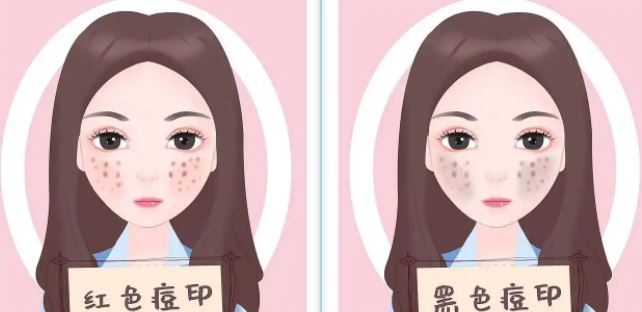 臉上紅色痘印幾個(gè)月都不消怎么辦？紅色痘印應(yīng)該怎么消除？